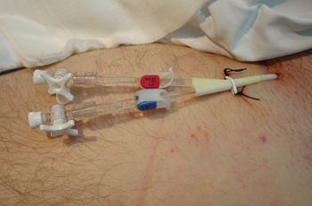 Catéter de doble luz para hemofiltración