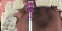 Los implantes dentales 3