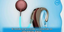 Cómo funciona un implante coclear