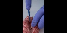 Brain dissection 2nd part