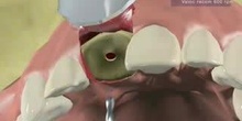 Los implantes dentales 2