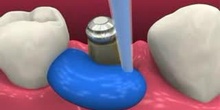 Los implantes dentales 4