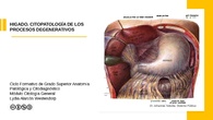 Hígado. Procesos degenerativos