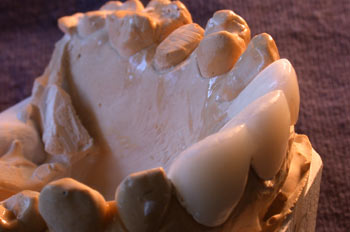 Molde de una maníbula humana