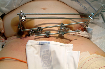 Fijador externo tipo Hoffman