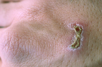 Costra de una herida