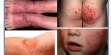 Dermatitis atópica