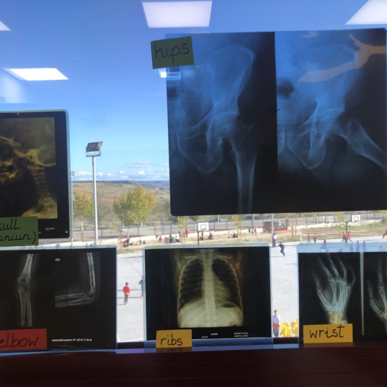 X ray Bones