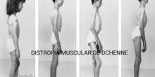 Distrofia Muscular de Duchenne
