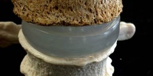 Disco Intervertebral