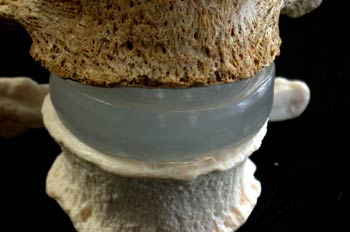 Disco Intervertebral