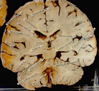Sección del  cerebro